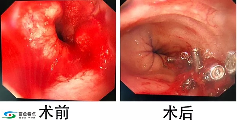 百色市人民医院多学科联合诊疗模式为患者生命保驾护航 百色,百色市,市人民医院,人民,人民医院